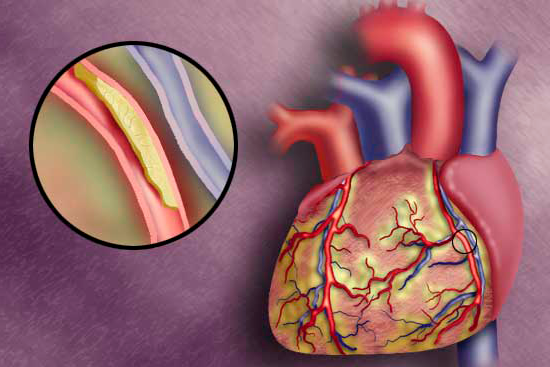 Атеросклероз сердца