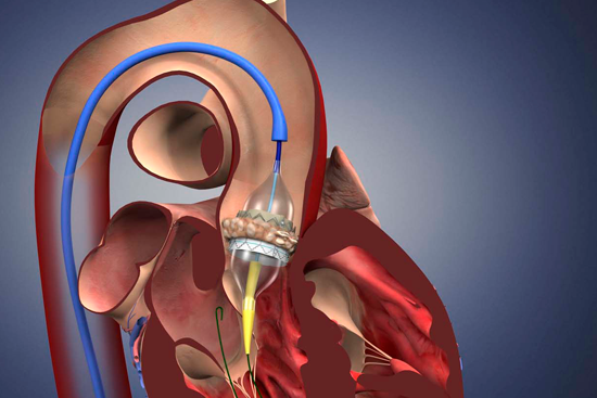 Порок аортального клапана: особенности протекания и лечения