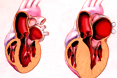 Как выявляется порок сердца?