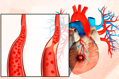 Признаки болезни ишемической болезни сердца